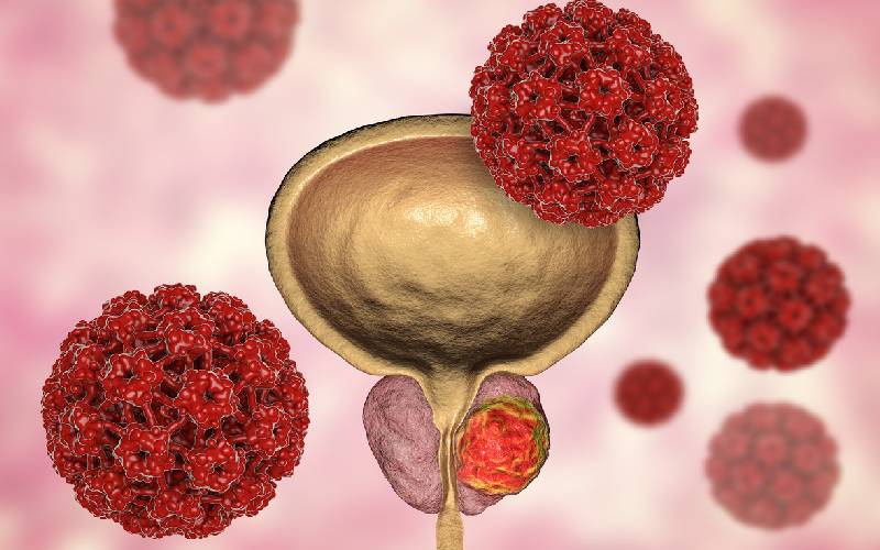 Cancer that plagues 1 in 7 African men